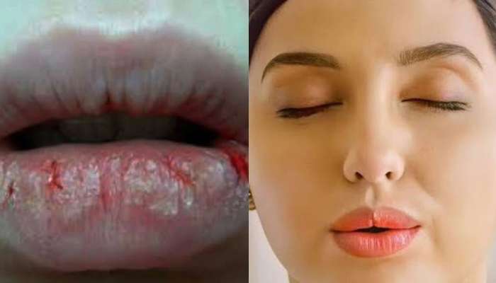 શિયાળાની સિઝનમાં આ કારણોથી ફાટે છે હોઠ, આ રીતે મેળવો Nora Fatehi જેવા Lips
