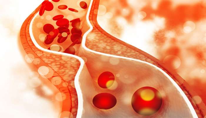 ખરાબ કોલેસ્ટ્રોલનું નામોનિશાન નહીં રહે, આ 10 ઉપાયો હાઈ Cholesterolમાં કરશે ફાયદા