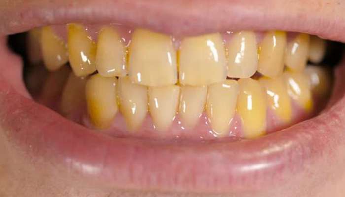 તમારા દાંતને પીળા કરી દેતી બીમારી શું છે અને સારવાર કેવી રીતે થાય છે?