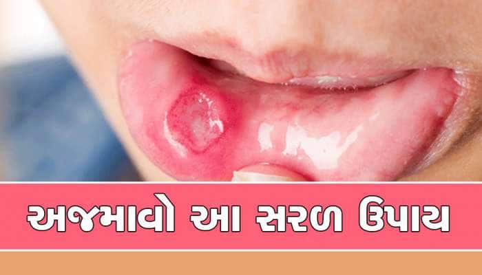Mouth Ulcer: તમને મોઢામાં ક્યારેય નહીં પડે ચાંદા, બસ કરી લો માત્ર આ 6 ઉપાય