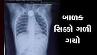એક રૂપિયાનો સિક્કો બાળકના અન્નનળીમાં ફસાયો, એક્સ-રે જોઈને ડર લાગશે