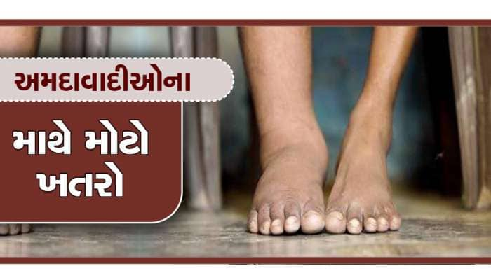 અમદાવાદમાં નવી બીમારીની એન્ટ્રી, આ રોગમા પગ 15 કિલોનો થઈ જશે