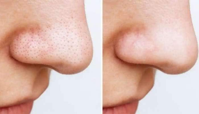 આ ઘરગથ્થુ નુસખા સામે નહીં ચાલે Blackheads ની જીદ, એકવારમાં જ થઈ જશે દુર