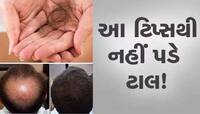 Hair fall: વાળ ખરવાથી તમને સતાવી રહ્યો છે ટાલ પડવાનો ડર? અપનાવો આ સુપર ટિપ્સ