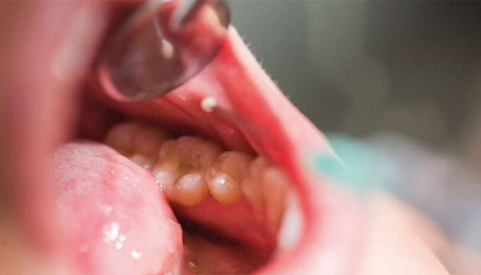 Oral Canser: કેમ સતત વધી રહ્યાં છે મોં ના કેન્સરના કેસો? જાણો શું હોય છે કેન્સરના પ્રાથમિક લક્ષણો