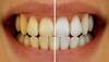 પીળા દાંતના કારણે આવે છે શરમ ? તો અજમાવો આ ચારમાંથી કોઈ એક નુસખો, પીળા દાંત થઈ જશે મોતી જેવા સફેદ