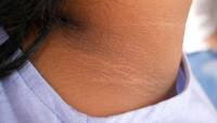 Dark Neck: ગરદન પર જામી ગયો છે કાળો મેલ? તો અપનાવો આ અસરકારક ઘરેલું ઉપાય