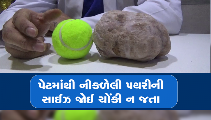 મધ્યપ્રદેશની ગરીબ દર્દી માટે ગુજરાતના તબીબ બન્યા તારણહાર, પેટમાંથી કાઢી દડા કરતા પણ મોટી પથરી