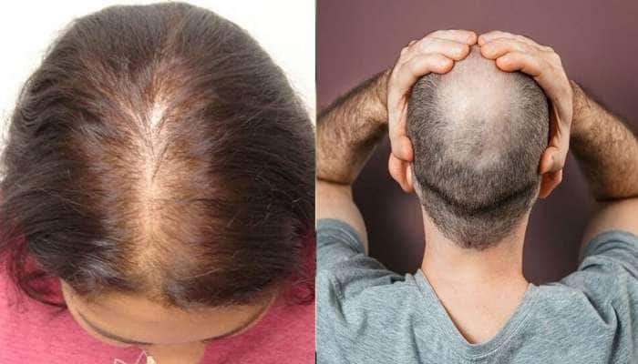 Hairfall Solution: વાળ ખરવાની સમસ્યા છે તો આ ઘરેલુ નુસખાઓ અજમાવો, ઝડપથી દેખાશે અસર