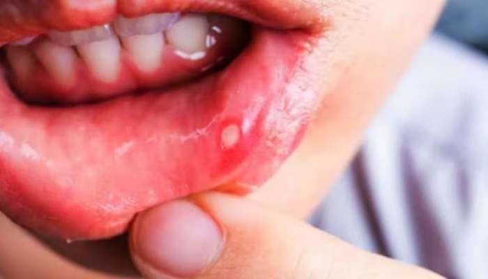 Mouth Ulcer થી તુરંત મળશે રાહત, જોરદાર અસર કરે છે રસોડામાં રહેલી આ વસ્તુ ચાંદા પર