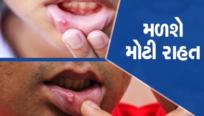 Mouth Ulcers: શું ગરમીને કારણે વારંવાર મોઢામાં પડે છે ચાંદા? અજમાવો આ 5 ઘરગથ્થુ ઉપાય