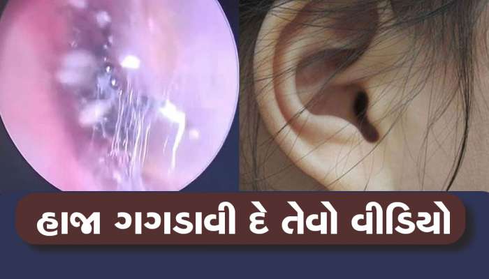 મહિલાના કાનમાં દુ:ખાવો થતા હોસ્પિટલ પહોંચી, તપાસમાં જે નીકળ્યું...ખાસ જુઓ Video 