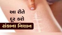 ચામડી પર ટાંકાના નિશાનથી પરેશાન છો? ફટાફટ આ ઉપાય અજમાવો, થશે દૂર!