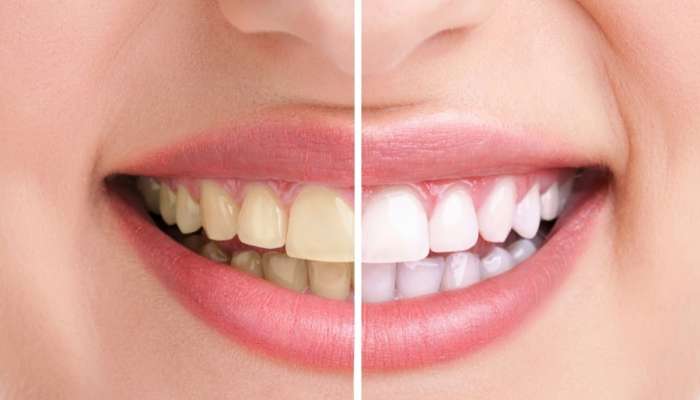 પીળા દાંત, કેવિટી અને શ્વાસની દુર્ગંધથી પરેશાન છો? આજથી જ શરુ કરો આ 4 ઉપાય