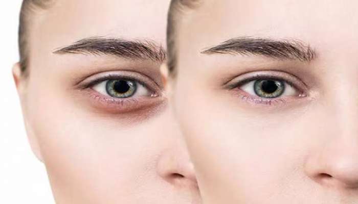 Skin Care: 3 દિવસમાં દુર કરવા હોય ડાર્ક સર્કલ તો દૂધ સાથે મિક્સ કરી લગાવો આ વસ્તુ