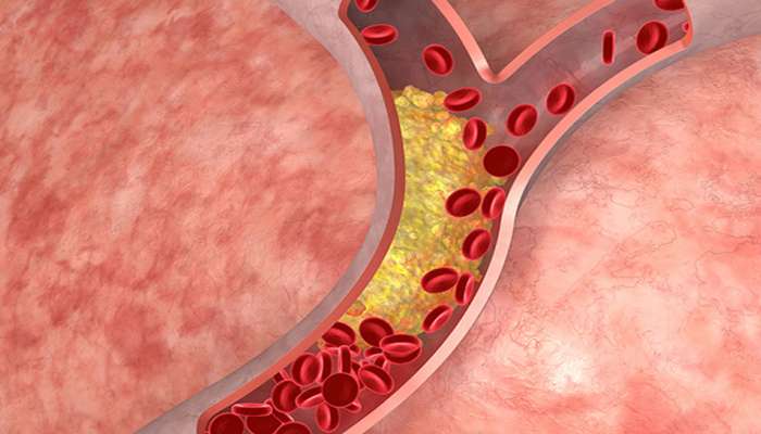 Bad Cholesterol ને શરીરમાંથી દુર કરે છે આ 5 વસ્તુઓ, નસેનસની થઈ જશે સફાઈ