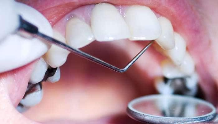 Teeth Cavity: શું તમે પણ દાંતમાં કેવિટી કે સડાથી પરેશાન છો? તો અજમાવો આ ઉપાય