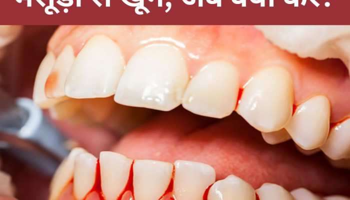 Gum Bleeding: પેઢાંમાંથી લોહી નિકળે છે તો ગભરાશો નહી, ઘરે જ કરો આ 4 ઉપાય