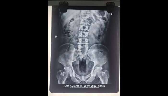 કમર નીચે દુ:ખાવો થતા મજૂર હોસ્પિટલ પહોંચ્યો, X-ray જોઈને ડોક્ટરોના હોશ ઉડ્યા