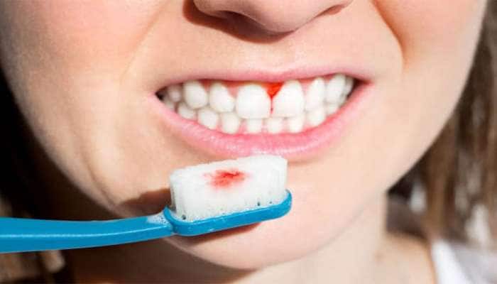 Gum Bleeding: બ્રશ કરતી વખતે પેઢામાંથી લોહી નીકળે તો અપનાવો આ 3 માંથી કોઈ એક ઉપાય