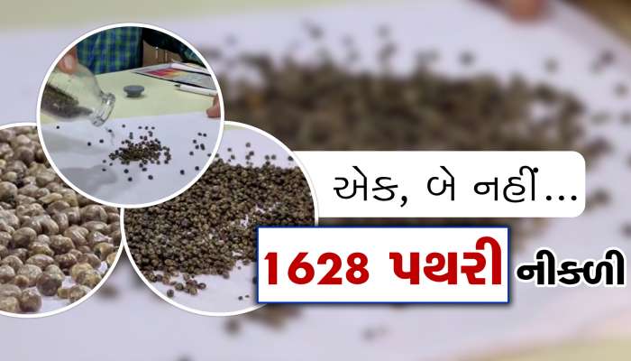 એક-બે નહીં... યુવાનના શરીરમાંથી નીકળી 1628 પથરી, ડૉક્ટર પણ જોતા જ રહી ગયા