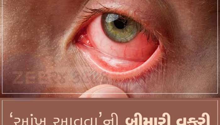 સાચવજો..ગુજરાતમાં વધી રહ્યો છે આંખનો રોગ,સૌરાષ્ટ્રની સૌથી મોટી સરકારી હોસ્પિટલ ઉભરાઈ