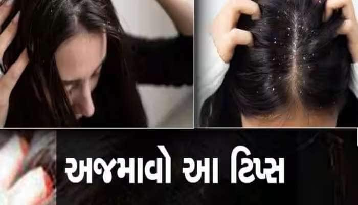 ચોમાસામાં ડેન્ડ્રફથી પરેશાન છો, આ રીતે સરસવના તેલનો કરો ઉપયોગ