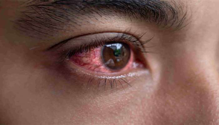 Eye Flu: જો તમને કે પરિવારમાં કોઈને પણ આવી હોય આંખ તો તુરંત અજમાવો આ ઘરેલુ નુસખા