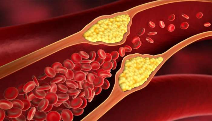Bad Cholesterol: ખરાબ કોલેસ્ટ્રોલને શરીરમાંથી બહાર કાઢી નાખશે આ ઘરેલુ વસ્તુઓ, ટ્રાય કરી જુઓ એકવાર