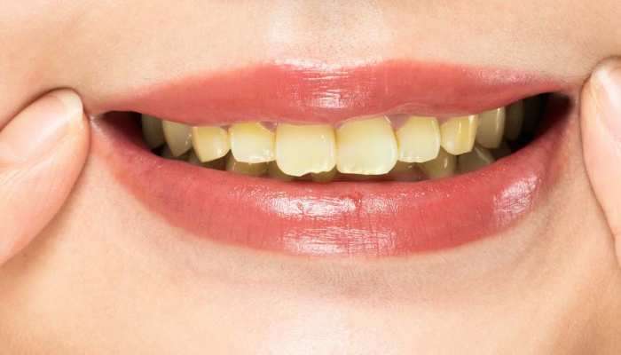 Teeth Whitening: બસ આ વસ્તુના ઉપયોગથી તમારા દાંત થઈ જશે સફેદ, ચમકવા લાગશે