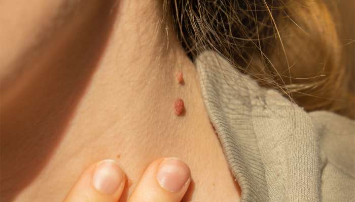 Mole Removing Tips: સર્જરી વિના ચહેરા પરથી રાતોરાત ગાયબ થઇ જશે તલના નિશાન, અપનાવો આ ઘરેલુ ઉપાય