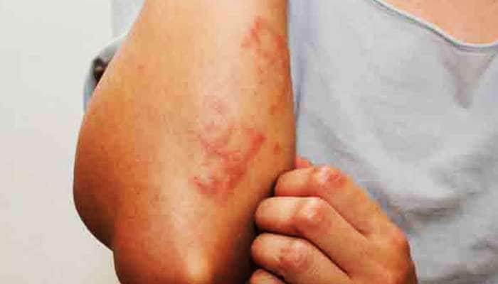 skin problems in monsoon: ચોમાસામાં કેમ વધે છે ચામડીના રોગો? જાણો કારણો અને ઉપચાર