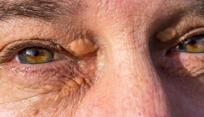 ડાયાબિટીસના પ્રારંભિક ચિહ્નો આંખોમાં કેવી રીતે દેખાય છે? અવગણના કરવી મોંઘી પડશે!