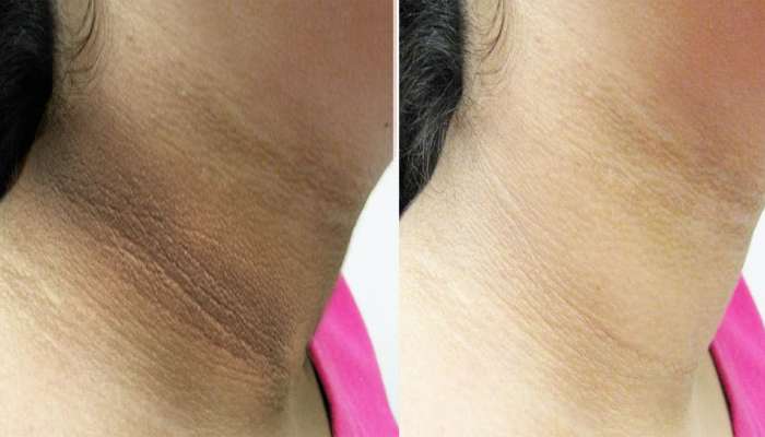 Dark Neck: ગરદન પર જામેલા મેલને 10 મિનિટમાં દુર કરી દેશે ખાવા-પીવાની આ વસ્તુઓ, જાણો ઉપયોગ કરવાની રીત