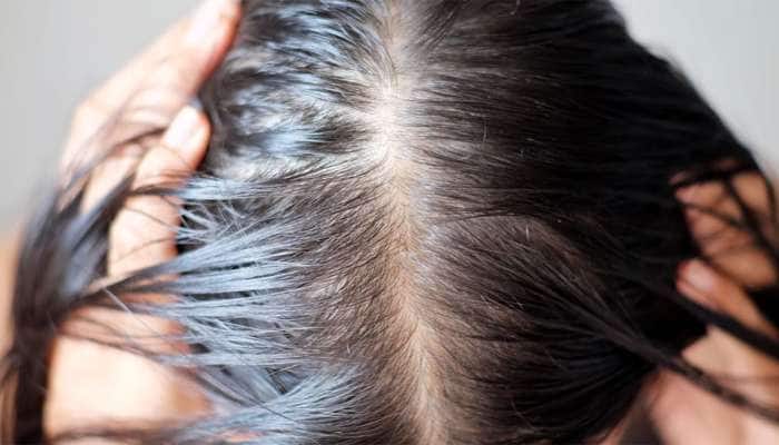 Hair Care: ખરતા વાળને અટકાવશે આ 5 સુપરફૂડ, ઝડપથી લાંબા થશે વાળ