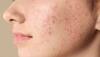 Acne Scars: ખીલના કારણે પડેલા ડાઘ દુર કરવા આ 2 રીતે કરો ટમેટાનો ઉપયોગ, 7 દિવસમાં દેખાશે અસર