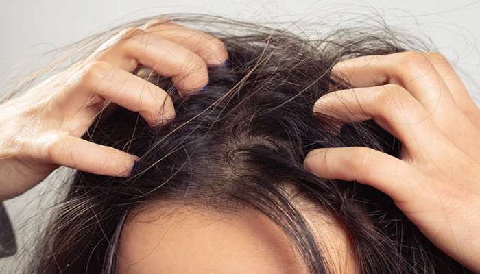 Itchy Scalp: માથામાં આવતી ખંજવાળથી પરેશાન છો ? આ સરળ ઉપાય તમારી સમસ્યા એકવારમાં કરશે દુર