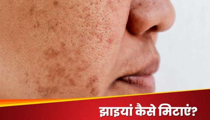 Pigmentation: રસોડામાં રાખેલી આ વસ્તુઓની મદદથી કરચલીઓ થશે દૂર, ચહેરો દેખાશે બેદાગ