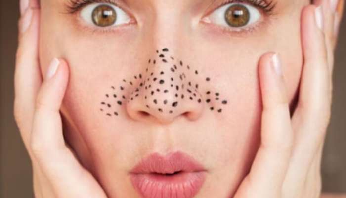 Blackheads Home Remedies: ચહેરા પર જામેલા બ્લેક હેડ્સ દૂર કરવા અજમાવો આ ઘરેલુ નુસખા