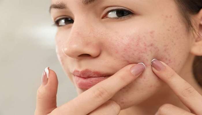 Skin Care: ખીલને દૂર કરવા ટ્રાય કરો આ પાંચમાંથી કોઈ એક ઉપાય, એક વીકમાં ખીલ અને ડાઘ બંને હશે ગાયબ