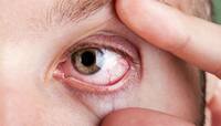 Dry Eye: શિયાળામાં વધી જાય છે આંખમાં ડ્રાયનેસ, આ રીતે રાખશો ધ્યાન તો નહીં વધે તકલીફ