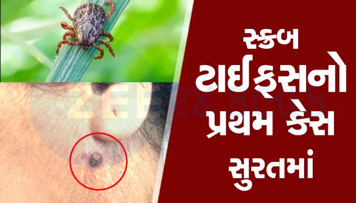 આદિવાસી મહિલાને જંગલમાં કાન પાસે જીવડું કરડ્યું, ને બેક્ટેરિયા આખા શરીરમાં ફેલાયા 