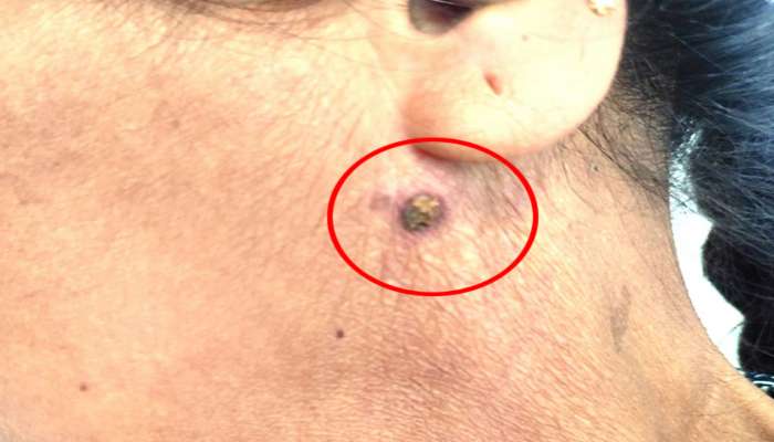 ગુજરાતમાં સ્ક્રબ ટાઈફસ બિમારીનો પહેલો કેસ; જંગલમાં મહિલાને જીવાતે માર્યો હતો ડંખ