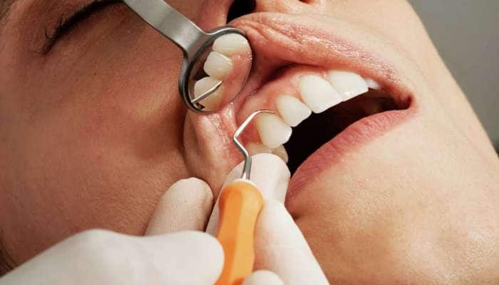 Teeth Cavity: સડેલા દાંતના લીધે સ્માઇલ સંતાડવી પડે છે!!! તો આ રીતે મેળવો છુટકારો