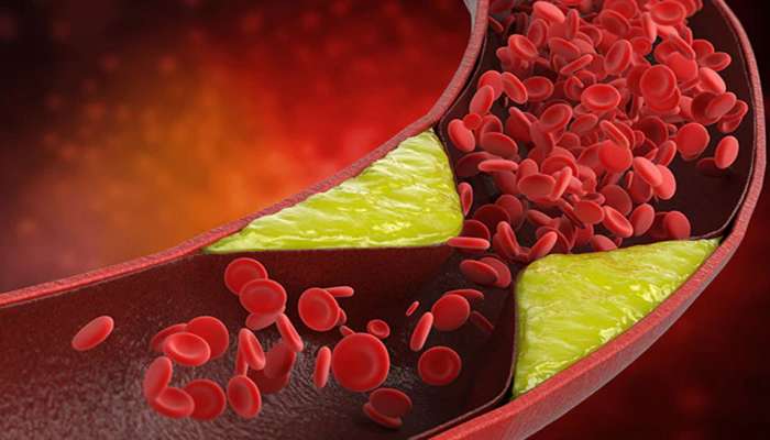 Bad Cholesterol: માત્ર 5 દિવસમાં બેડ કોલેસ્ટ્રોલને કંટ્રોલ કરવા અજમાવો આ 5 માંથી કોઈ એક આયુર્વેદિક ઉપાય