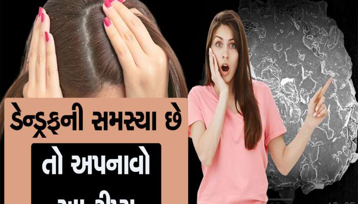 How To Remove Dandruff : આ 3 ઘરેલુ નુસ્ખાથી વાળમાંથી ગાયબ થઈ જશે ડેન્ડ્રફ 