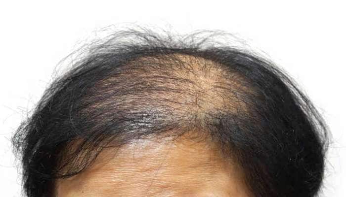 Hair Growth Tips:ટકલામાં પણ વાળ ઉગાડી શકે છે અસેરિયો, જાણો કેવી રીતે કરવો તેનો ઉપયોગ