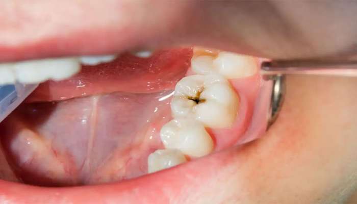 Oral Health: આ 5 ઘરગથ્થુ ઉપાયથી દાંતનો સડો થશે દુર, દુખાવાથી મળશે રાહત