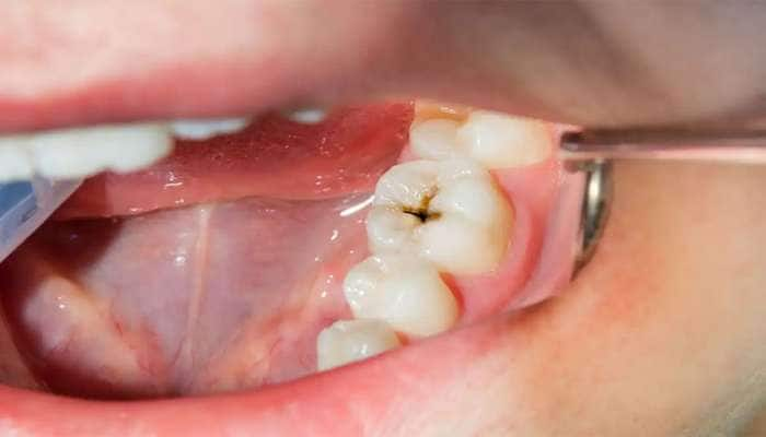 Oral Health: આ 5 ઘરગથ્થુ ઉપાયથી દાંતનો સડો થશે દુર, દુખાવાથી મળશે રાહત