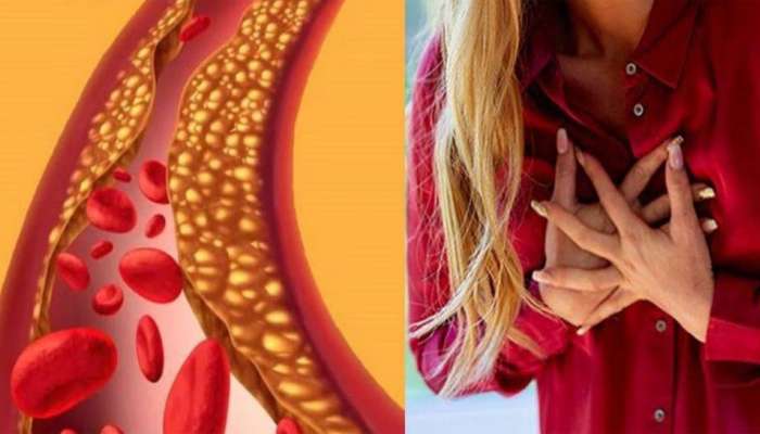 Bad Cholesterol: શરીરના આ અંગોમાં પણ દેખાય છે હાઈ બેડ કોલેસ્ટ્રોલના લક્ષણ, દેખાય તો તુરંત કરાવો ટેસ્ટ